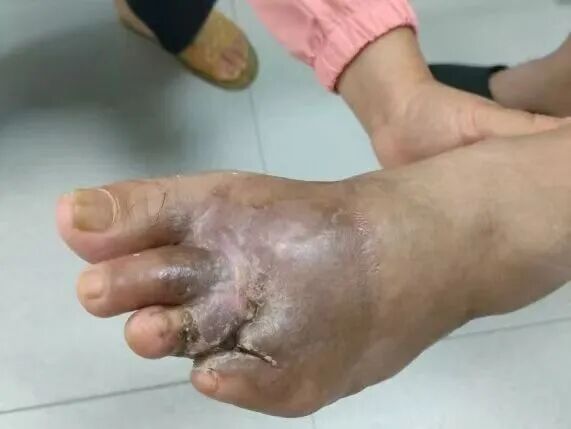 险遭截肢！5E对战
这家医院全力以赴，成功为重伤患者保住行走能力